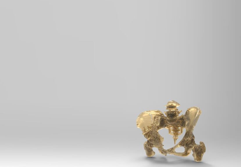 Una imagen digital médica de la pelvis de un paciente impresa con tecnología 3D. (Suministrada)