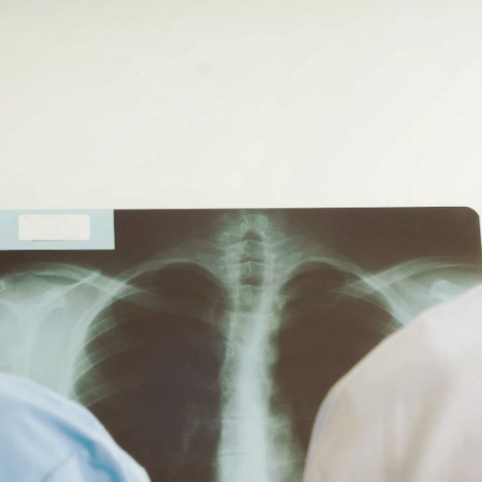 En América Latina, el cáncer de pulmón cobra 74,600 vidas anuales. (Shutterstock)