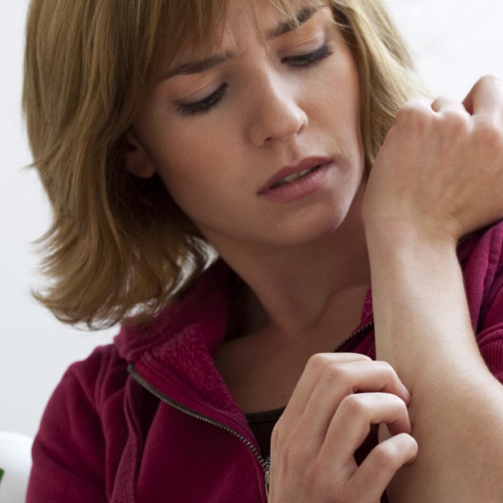 La picazón intensa es común entre los pacientes que padecen dermatitis atópica. (Shutterstock)