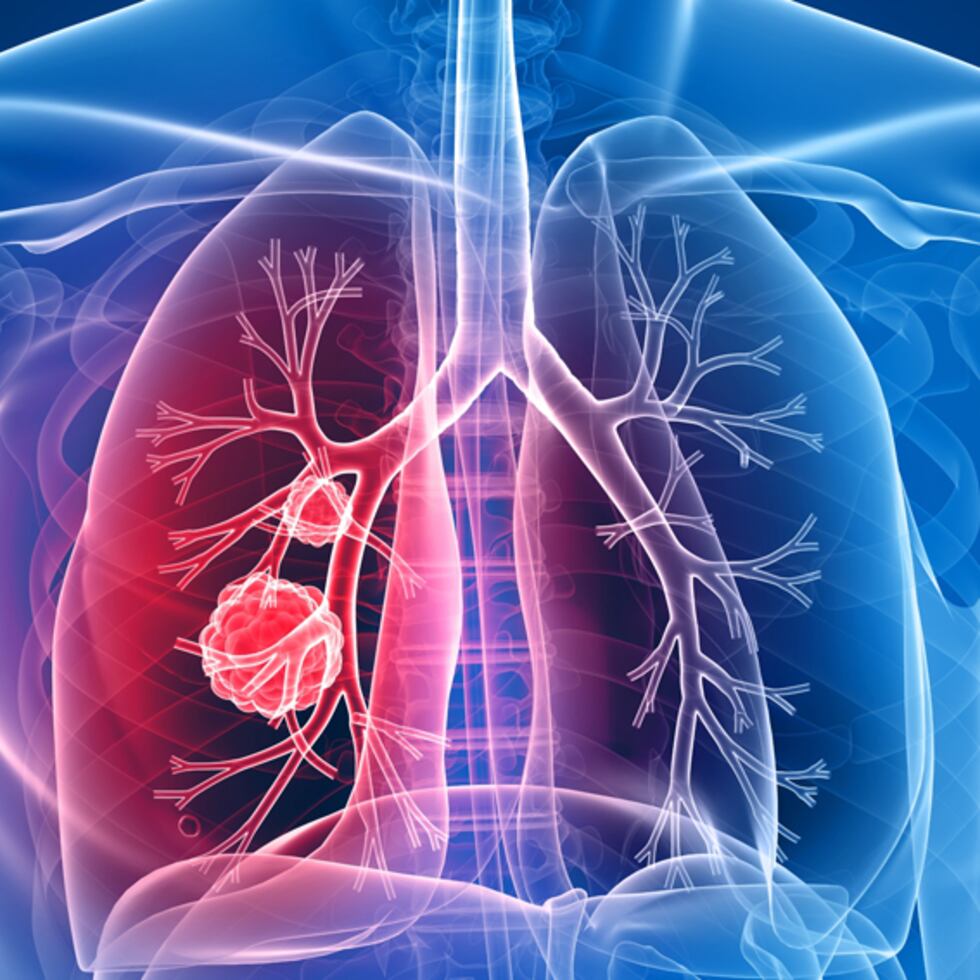 El acceso limitado a exámenes médicos significa que muchos tumores de pulmón generalmente se detectan en etapas avanzadas. (Shutterstock)