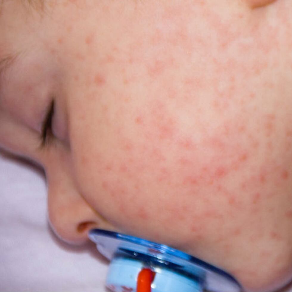 La dermatitis es una condición genética y un trastorno autoinmune de unas células conocidas como linfocitos TH2. (Shutterstock)